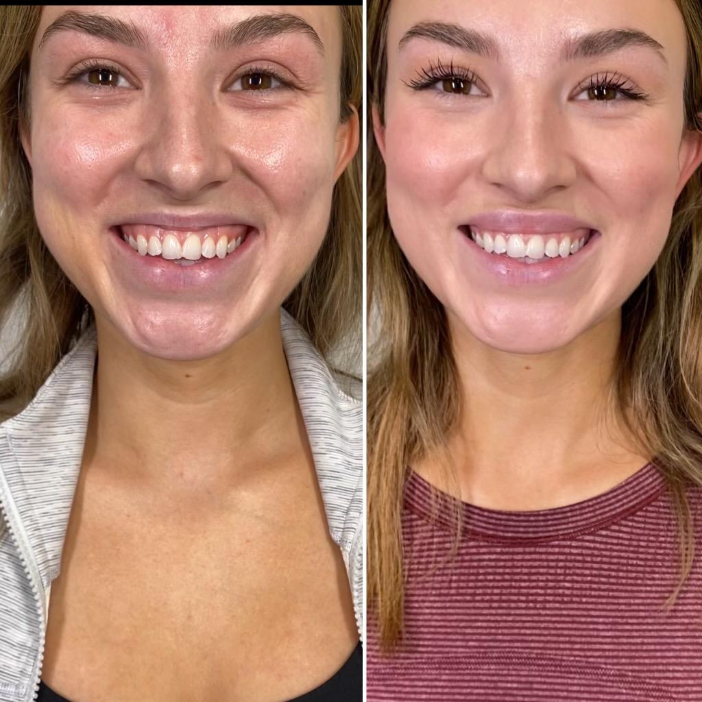 https://www.theperfectdose.com/wp-content/uploads/2024/10/Botox-Lip-Flip-bxa.jpg