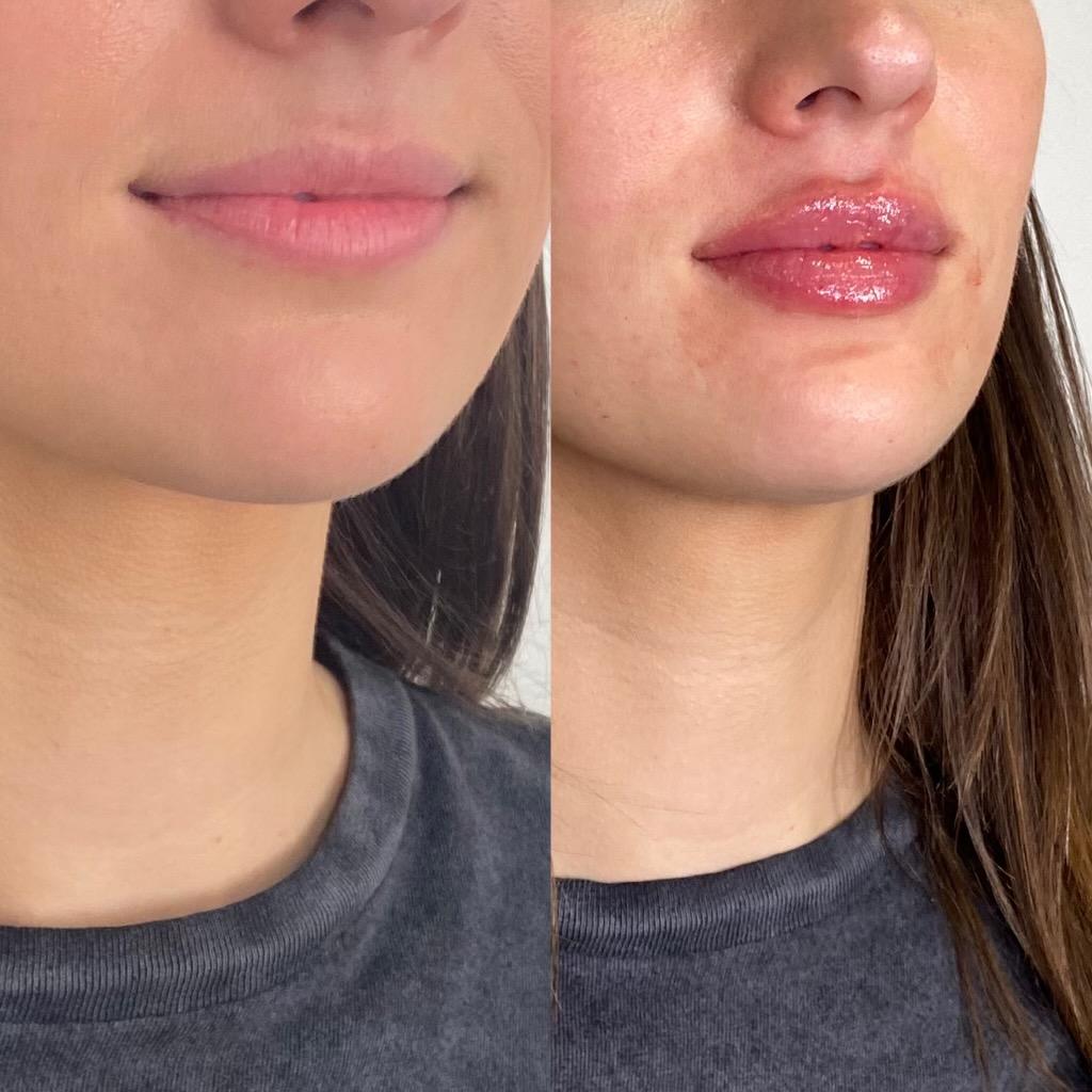 https://www.theperfectdose.com/wp-content/uploads/2024/10/lip-filler-bxa.jpg