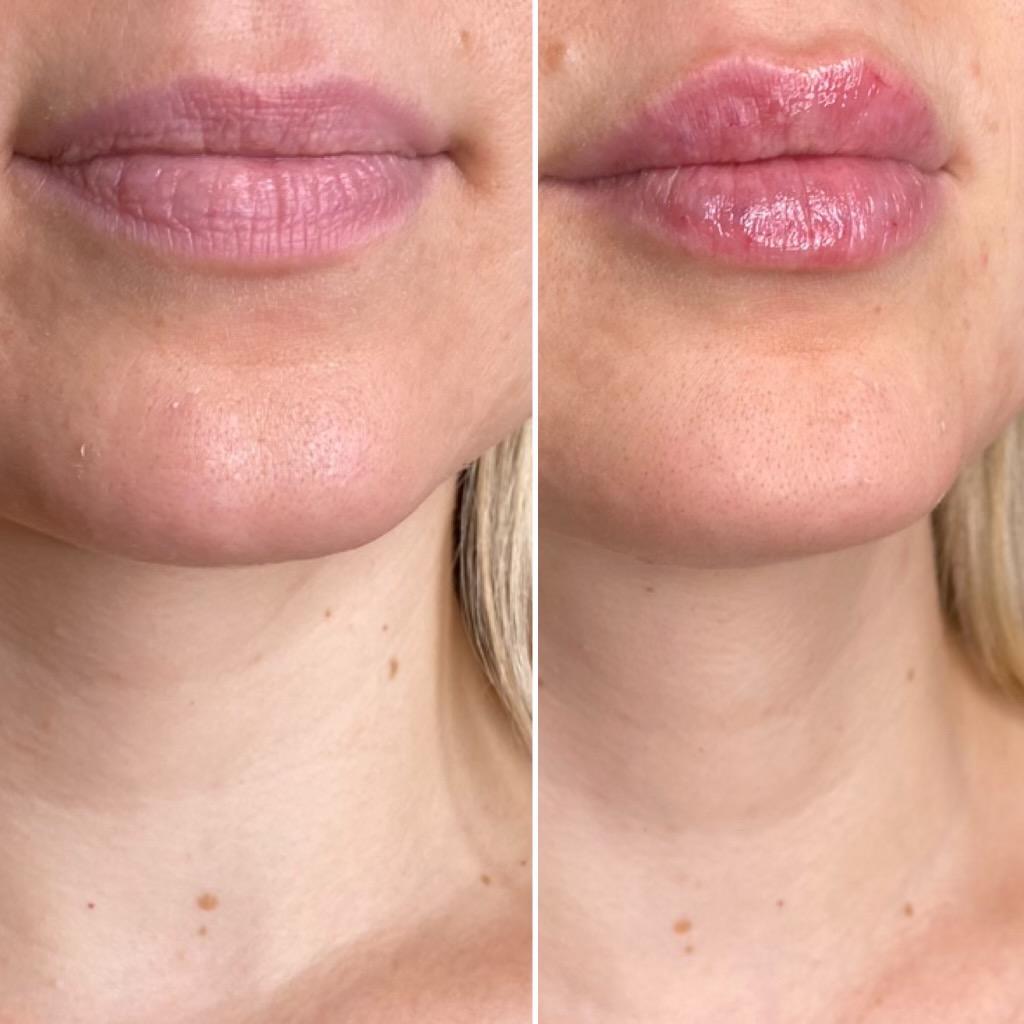 https://www.theperfectdose.com/wp-content/uploads/2024/10/lip-filler-bxa4.jpg