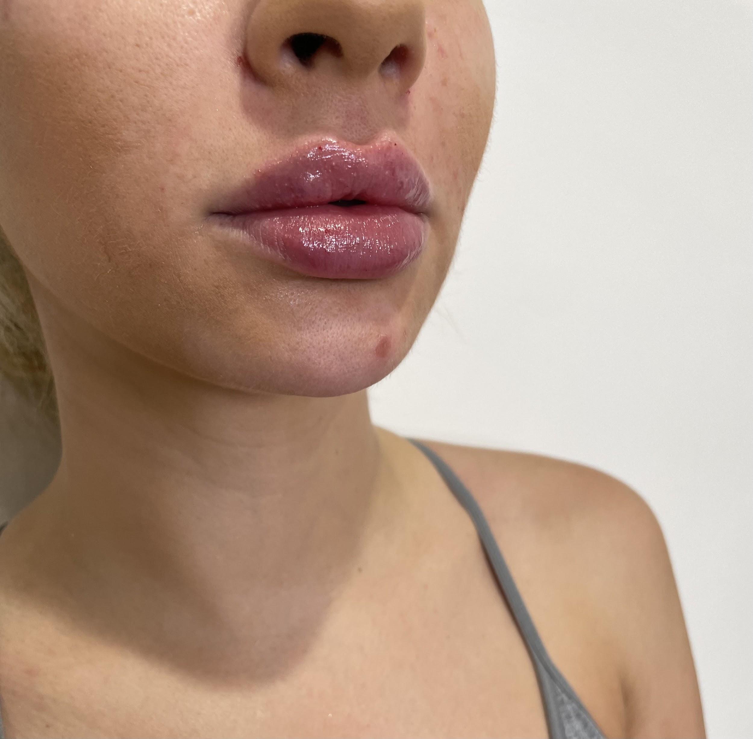 https://www.theperfectdose.com/wp-content/uploads/2024/10/lip-filler-bxa5.jpg